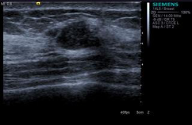 Screening Mammograms Should Be Performed Annually